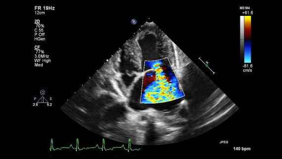 اکوکاردیوگرافی قلب تخطيط صدى القلب