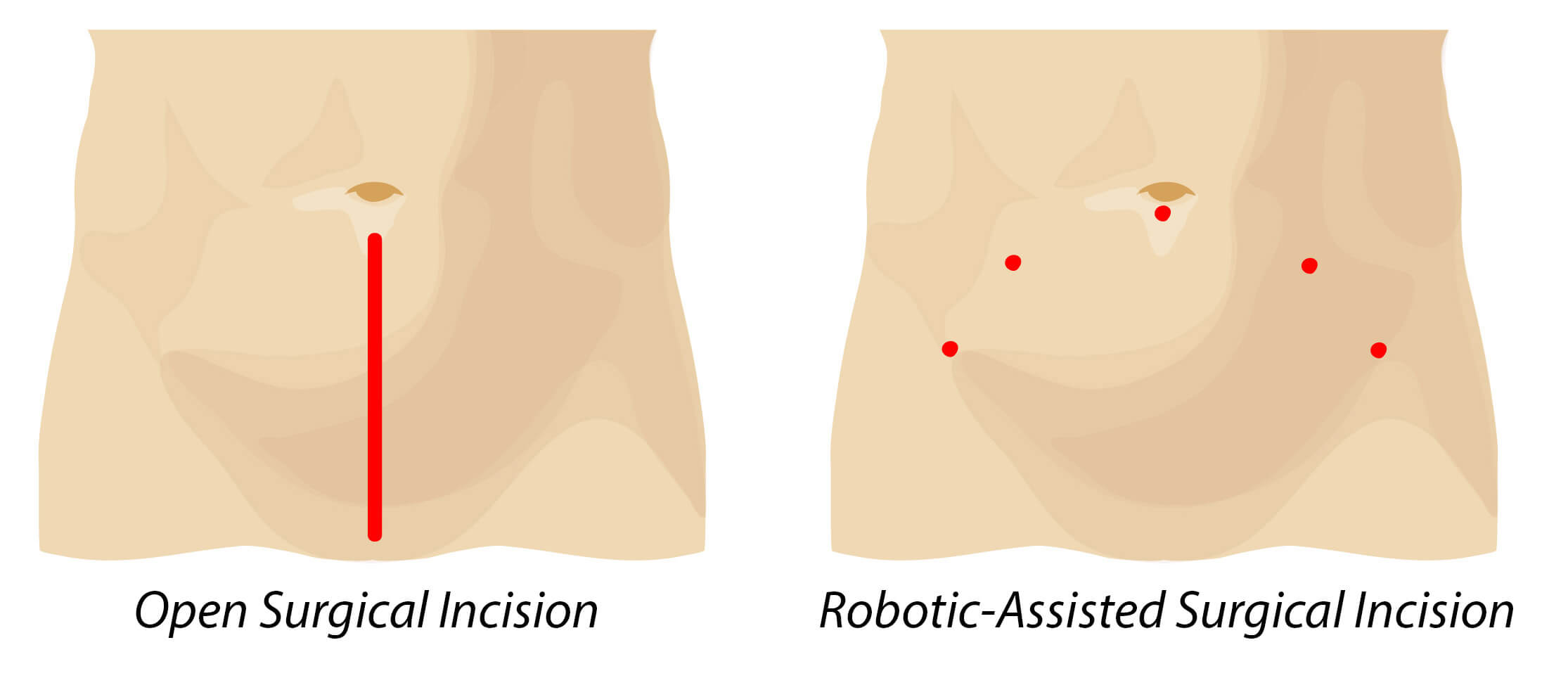 img046_incision_comparison_prostatectomy_sm-2