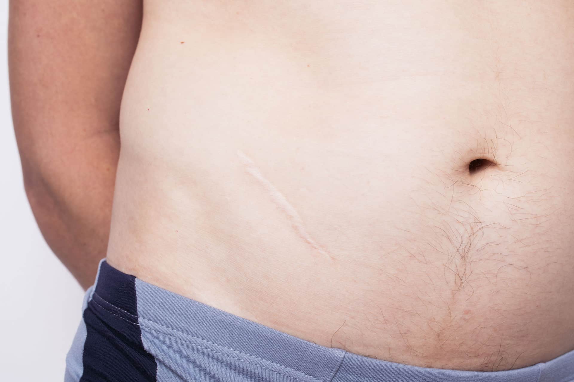 man-showing-appendix-scar-body-2