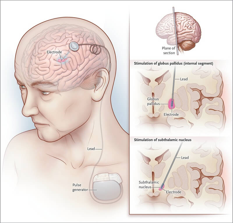 التحفيز العميق للدماغ (DBS) لعلاج مرض باركنسون تحریک عمیق مغزی DBS