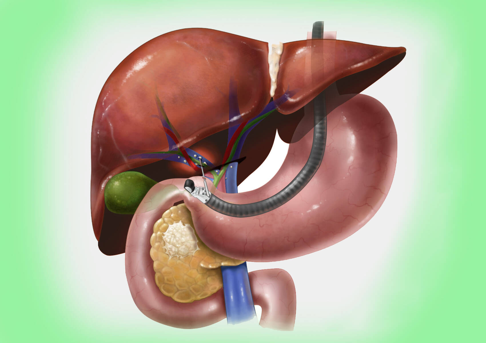 فوائد تصوير البنكرياس والأقنية الصفراوية بالتنظير الباطني بالطريق الراجع ERCP