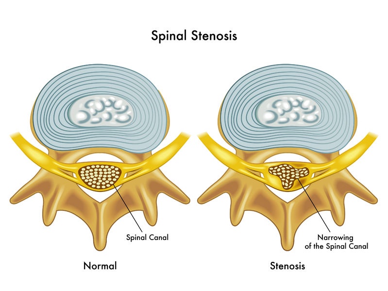 spinalstenosis23298019_m