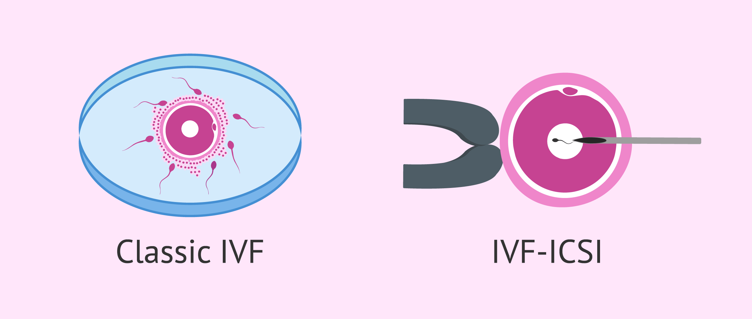 ivf-icsi