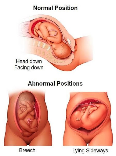 الولادة المهبلية الطبيعية