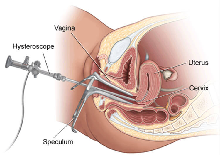 hysteroscopic-polypectomy