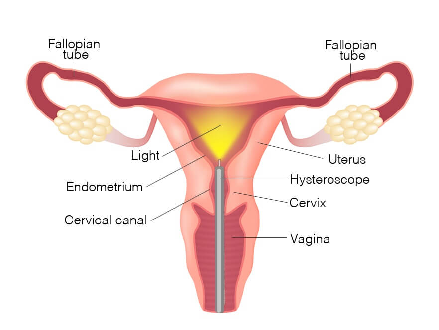 hysteroscopy-full-image