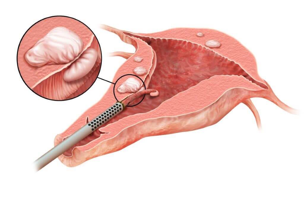 عملية استئصال الورم الليفي خارج الرحم 