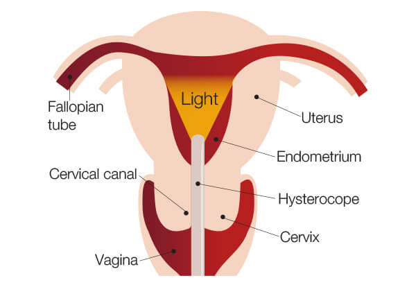 how-hysteroscope-works