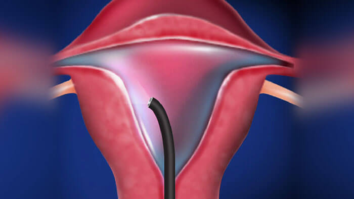 hysteroscopy_128022