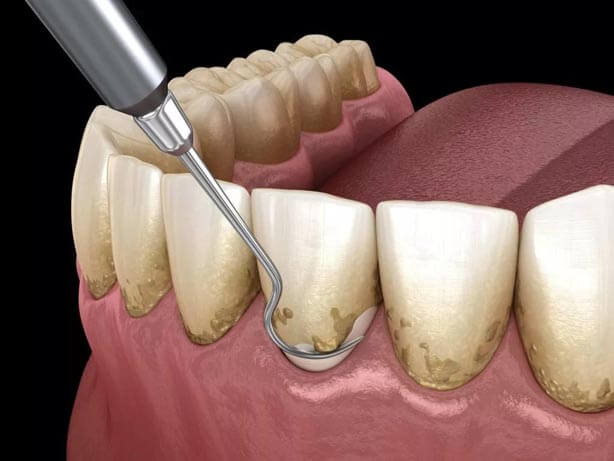 تقليح الأسنان وكشط الجذر