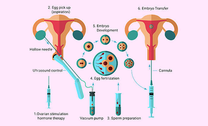 ivf-in-iran-2-2-2