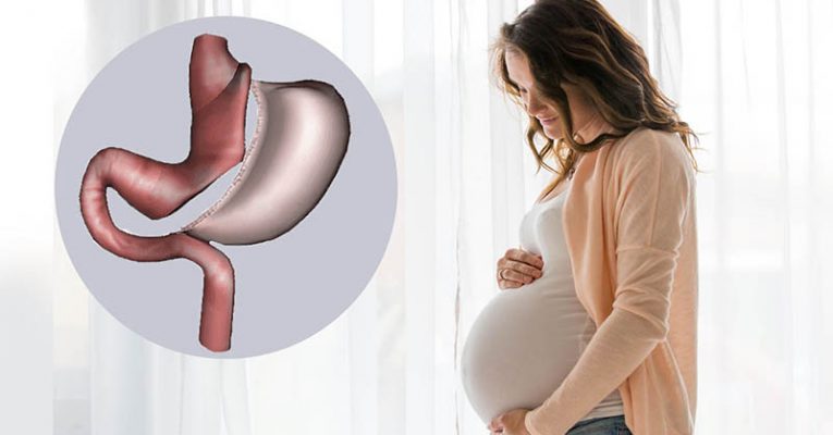 آثار إجراء عملية تكميم المعدة على الحمل