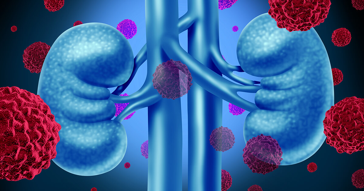 سرطان-الكلية-وأسبابه-الرئيسية