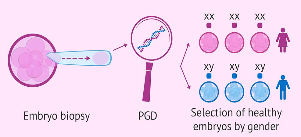 PGD چیست؟ PGD مخفف Preimplantation genetic diagnosis (تشخیص ژنتیکی قبل از کاشت) است. PGD یک تکنولوژی کمک باروری است که در پروسه IVF برای بالا بردن احتمال بارداری و زایمان موفق استفاده می‌شود. PGD تستی ژنتیکی روی سلول‌های گرفته شده از جنین است که کمک می‌کند بهترین جنین برای بارداری انتخاب شود و از انتقال بیماری ژنتیکی زوجی که حامل ژن هستند جلوگیری شود. PGD انواع مختلفی دارد که هرکدام برای یک اختلال به کار می رود. مثل PGT-A, PGT-M, PGT-SR انجام PGD به همه توصیه می‌شود اما بیشتر از همه برای کسانی لازم و مفید است که ریسک کروموزوم غیرعادی و یا بیماری خاص ژنتیکی دارند. از جمله زنانی که سقط‌های مکرر داشته‌اند یا در بارداری قبلی، نوزاد دارای کروموزوم غیرعادی بوده است. زنان بالای 38 سال و مردانی که اسپرم غیرعادی دارند احتمال بیشتری دارد جنین با مشکلات کروموزومی تولید کنند. به علاوه اگر شخصی بازآرایی ساختار کروموزوم ها را انجام دهد، PGD می تواند تشخیص دهد که کدام جنین دارای مقدار طبیعی ماده کروموزومی است.