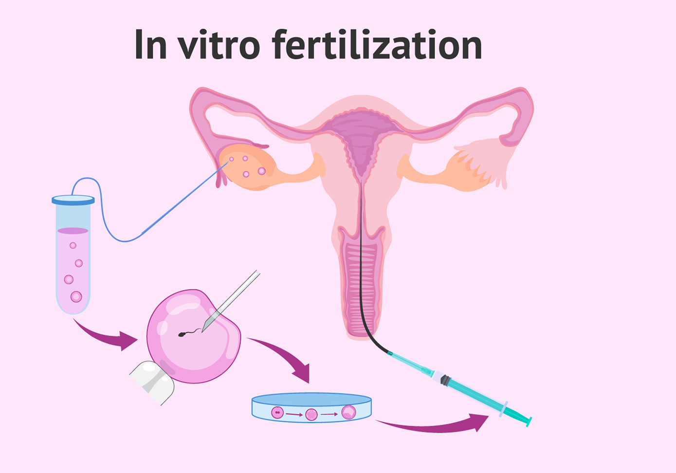 روش IVF چیست؟
