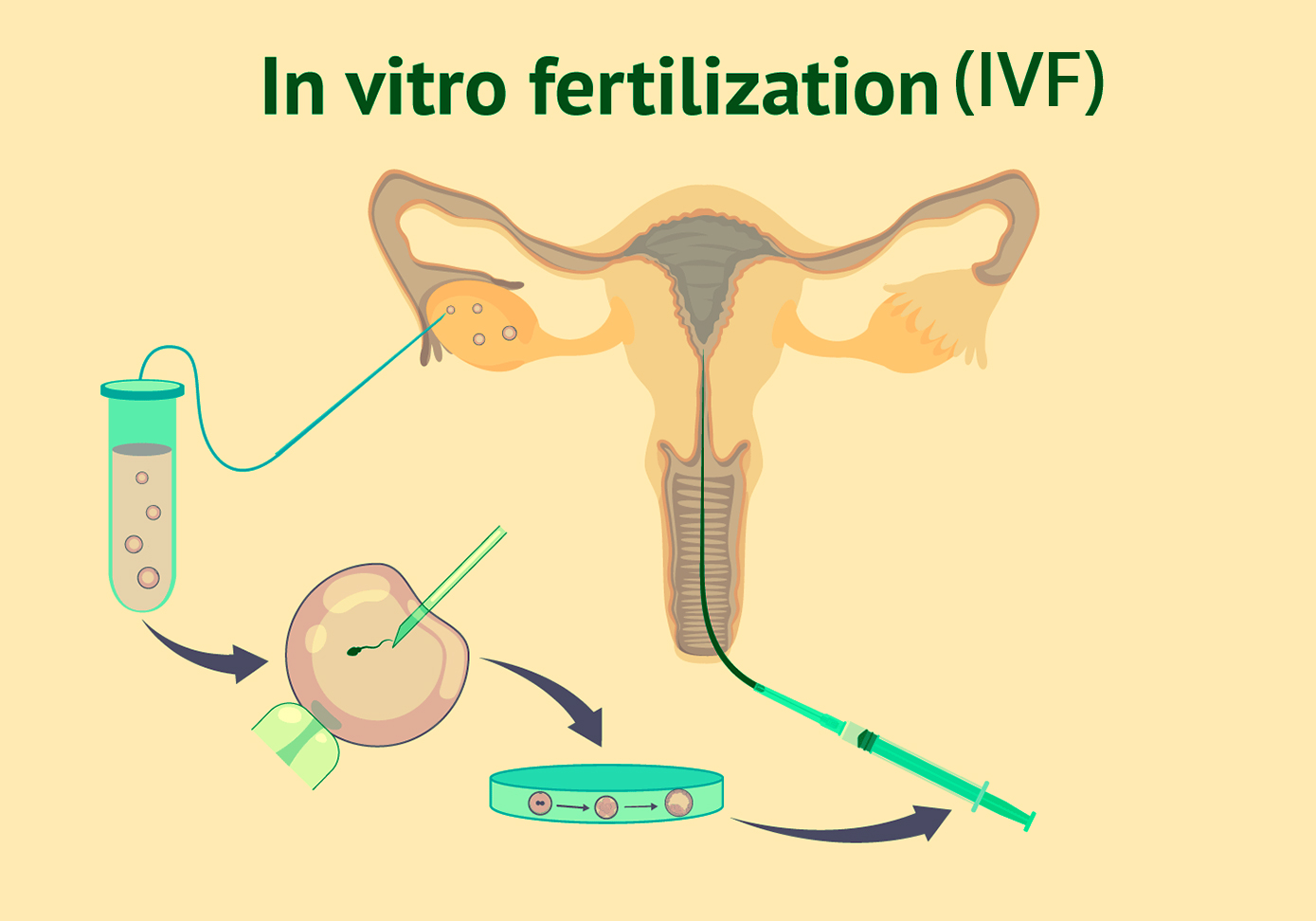 ما هي طريقة التلقيح الاصطناعي(IVF)؟