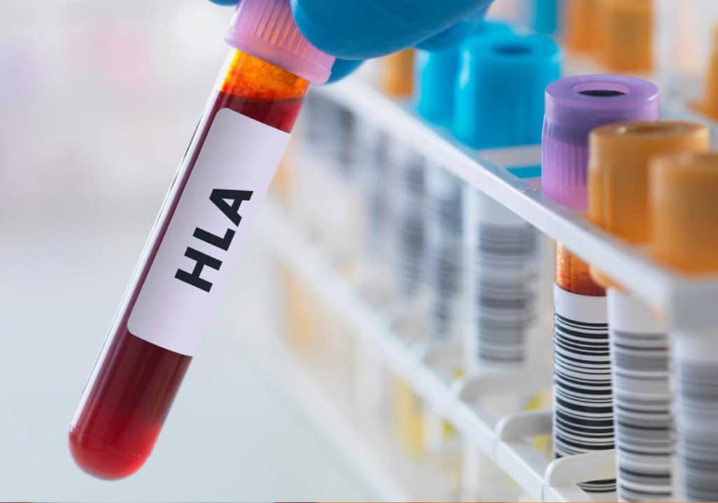 مستضد كريات الدم البيضاء البشرية (HLA) أو اختبار مطابقة الأنسجة