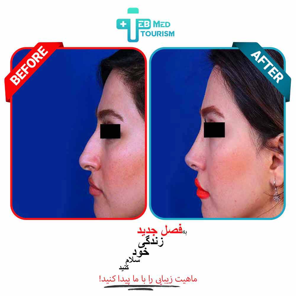 عكس قبل و بعد مشتريان