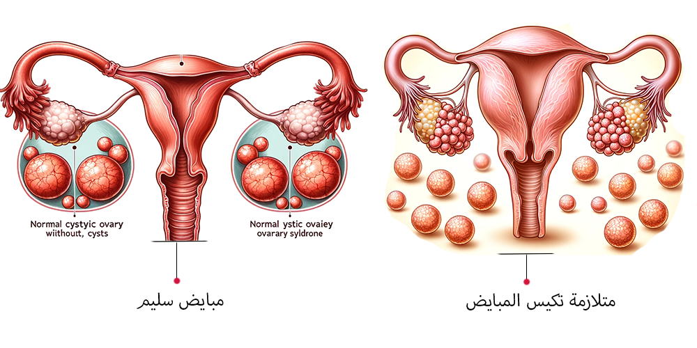 هل يستمر الحمل مع تكيس المبايض؟
