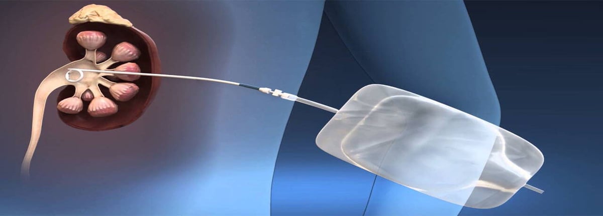 pcnl