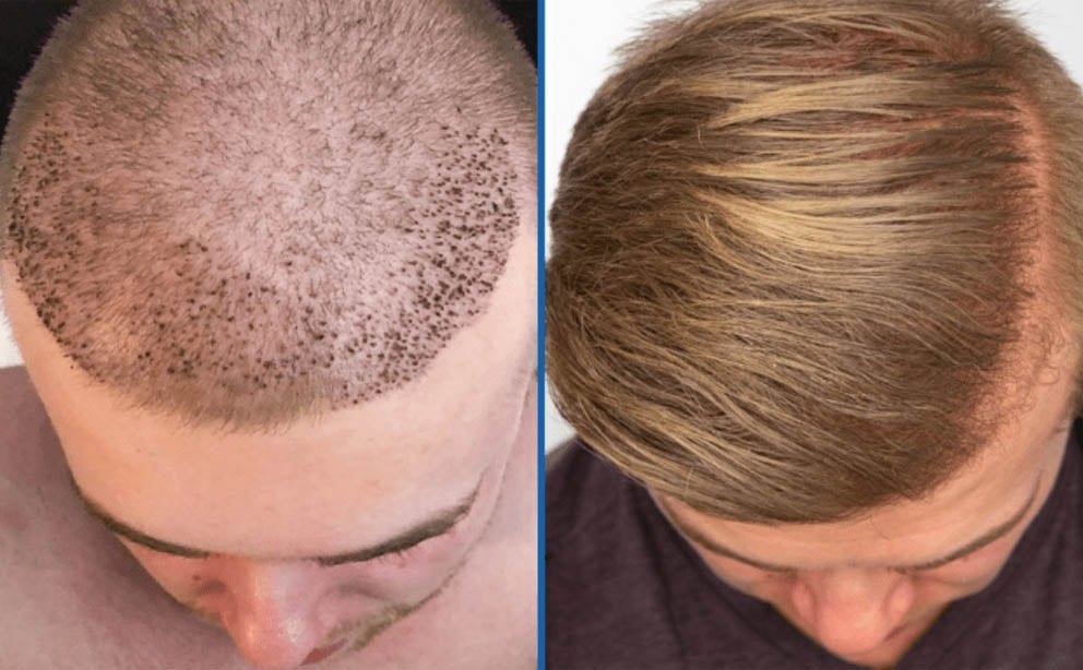 أفضل-الطریقة-لزراعة-الشعر