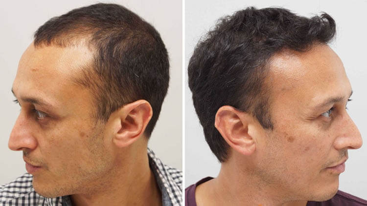 زراعة-الشعر-بدون-حلاقة