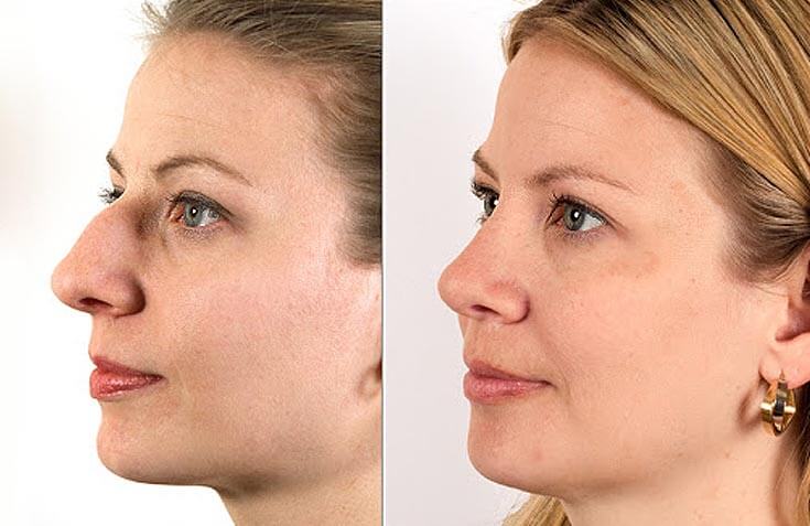 ما-هو-الفرق-بين-عملية-تجميل-الأنف
