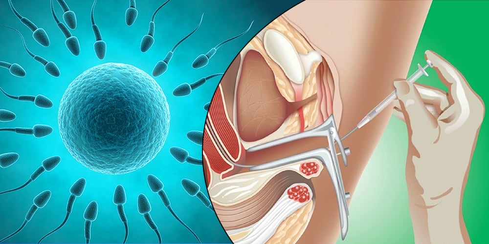 مقایسه-روش-iui-و-ivf