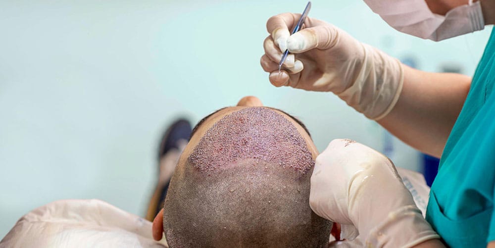 ما-مدى-نجاح-عملية-زراعة-الشعر