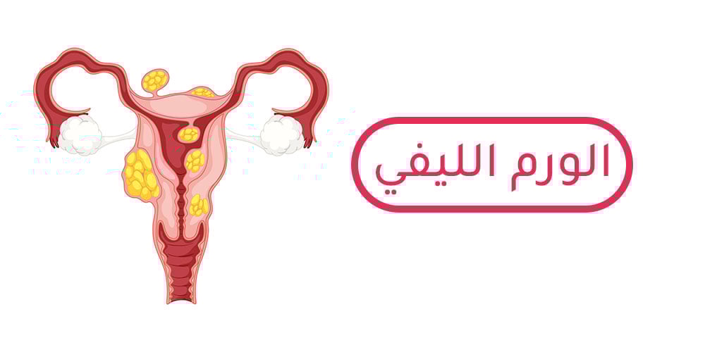 الورم-الليفي