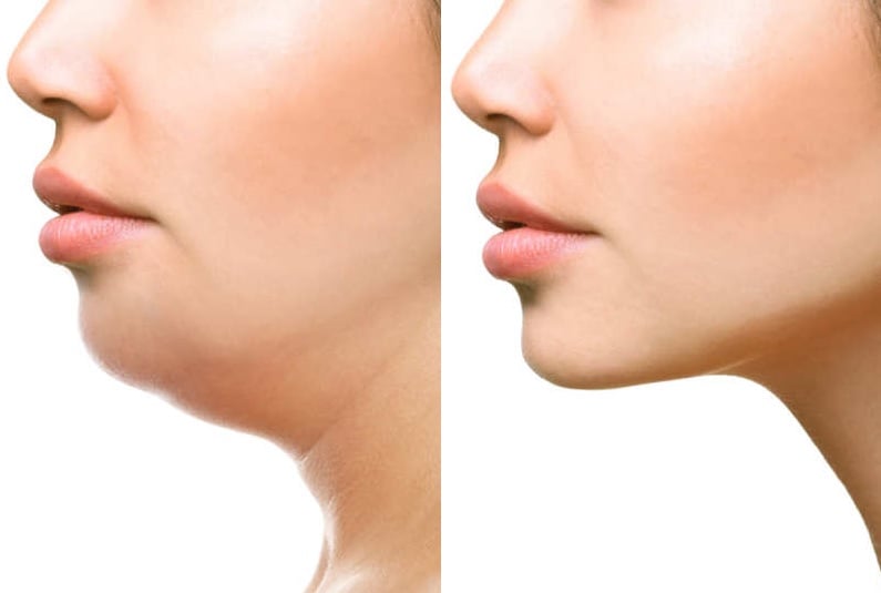 mesolipolysis