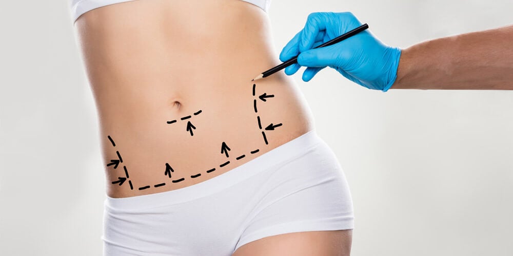 abdominoplasty-tummy-tuck