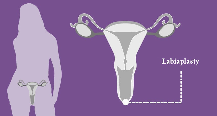labiaplasty
