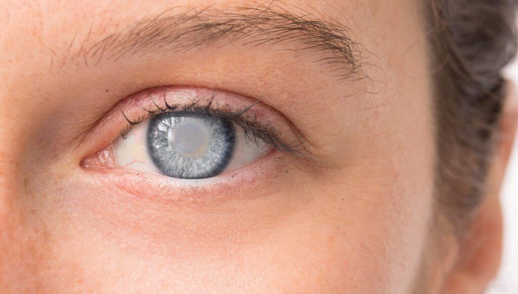 glaucoma-surgery