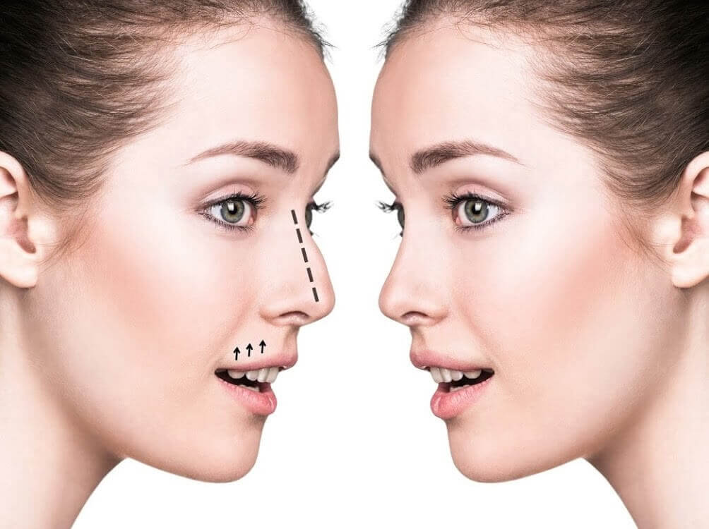 septoplasty-in-iran
