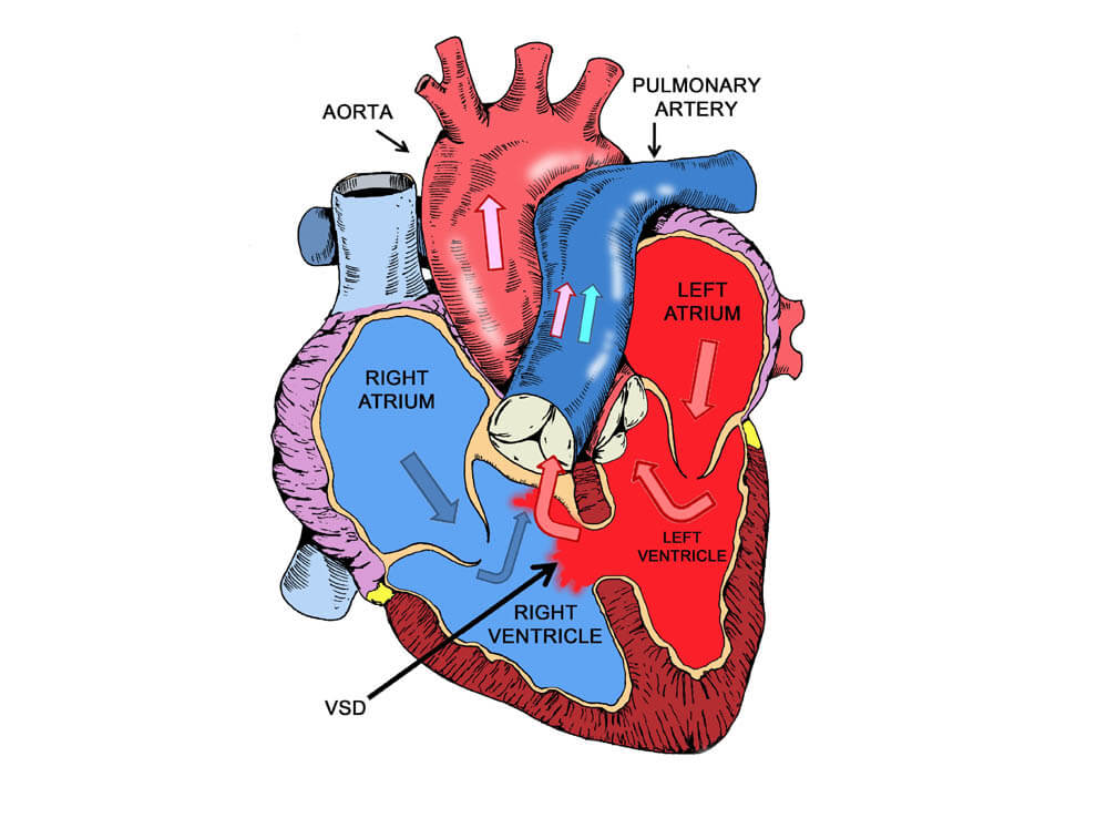 ventricular-septal-defect-vsd-repair-in-iran