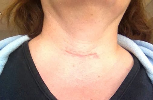 thyroidectomy-in-iran