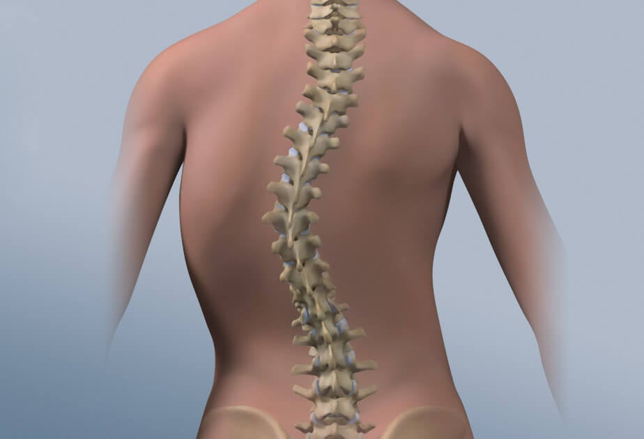 scoliosis-treatment-in-iran