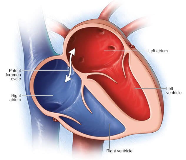 atrial-septal-defect-repair-asd-in-iran