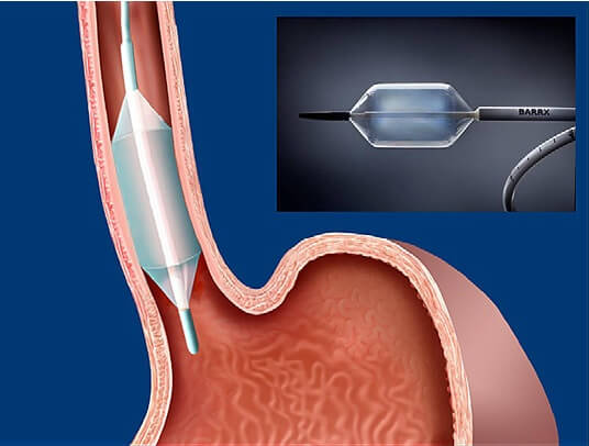 radiofrequency-ablation-or-rfa