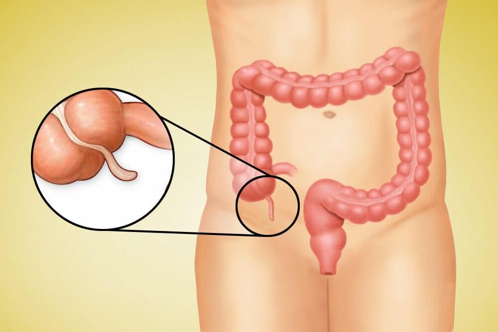appendix-removal