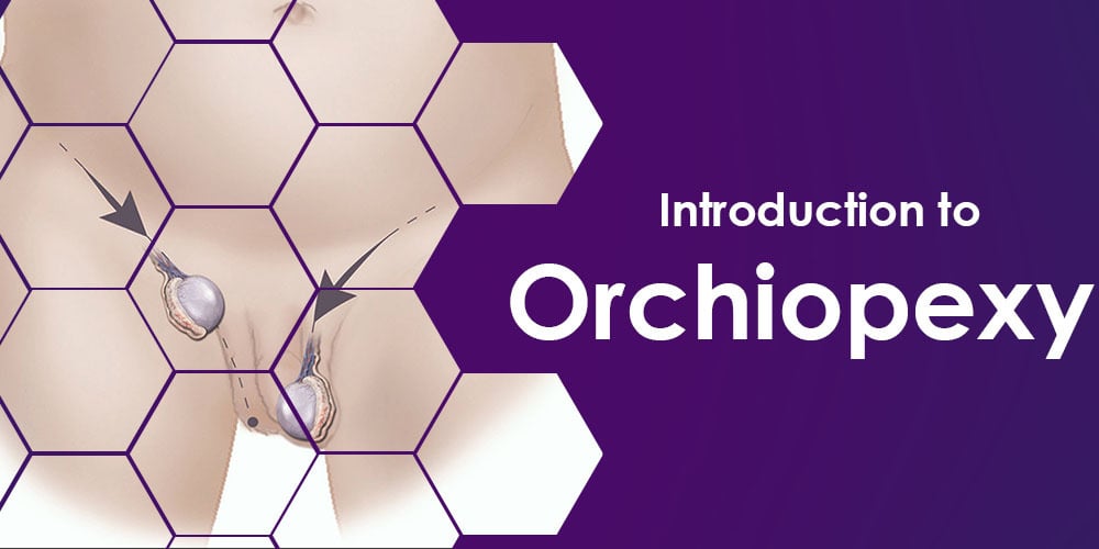 orchiopexy