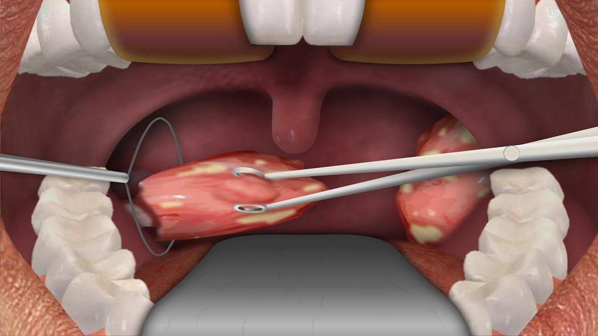 tonsillectomy