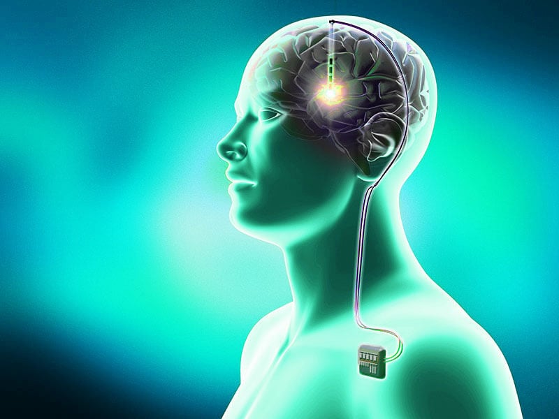 deep-brain-stimulation-dbs