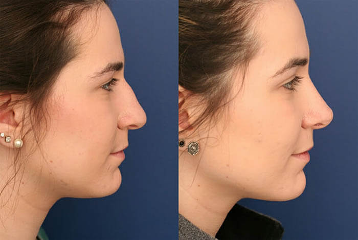 notes-to-find-the-best-rhinoplasty-surgeon