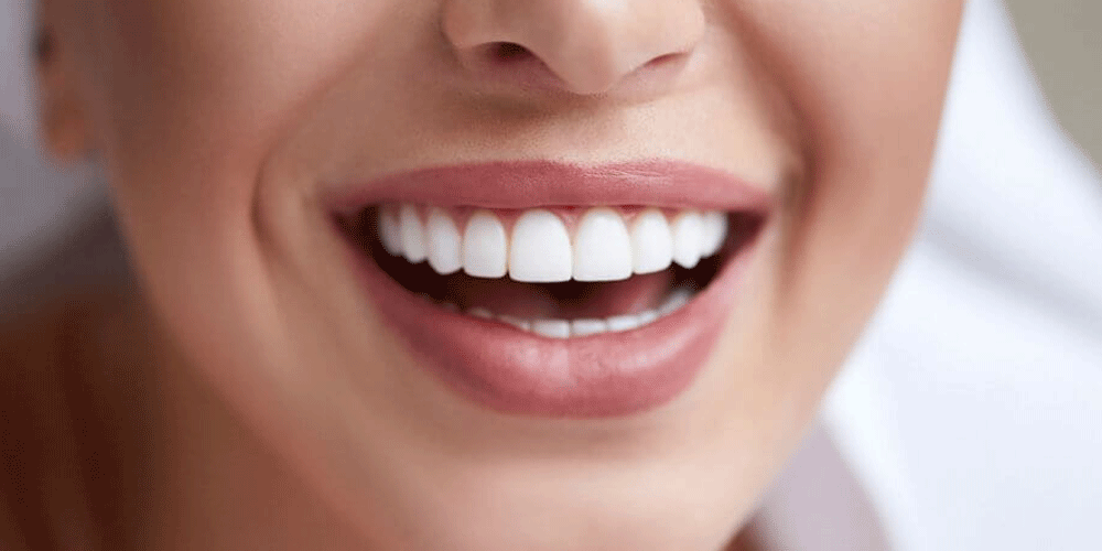 5-types-of-dental-veneers-in-hollywood-smile
