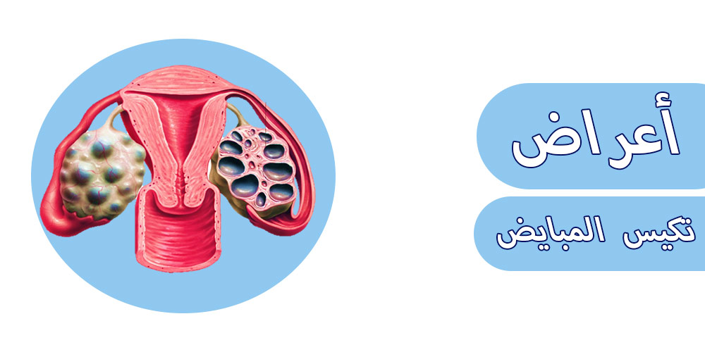 أعراض تكيس المبايض