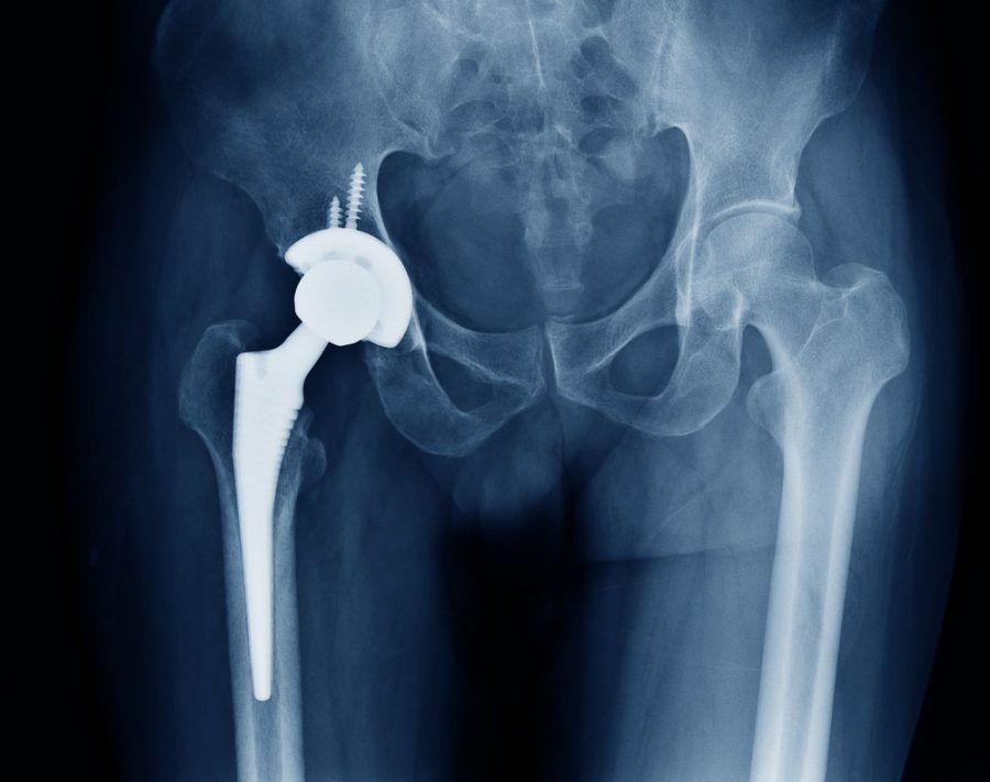 Everything about hip replacement surgery