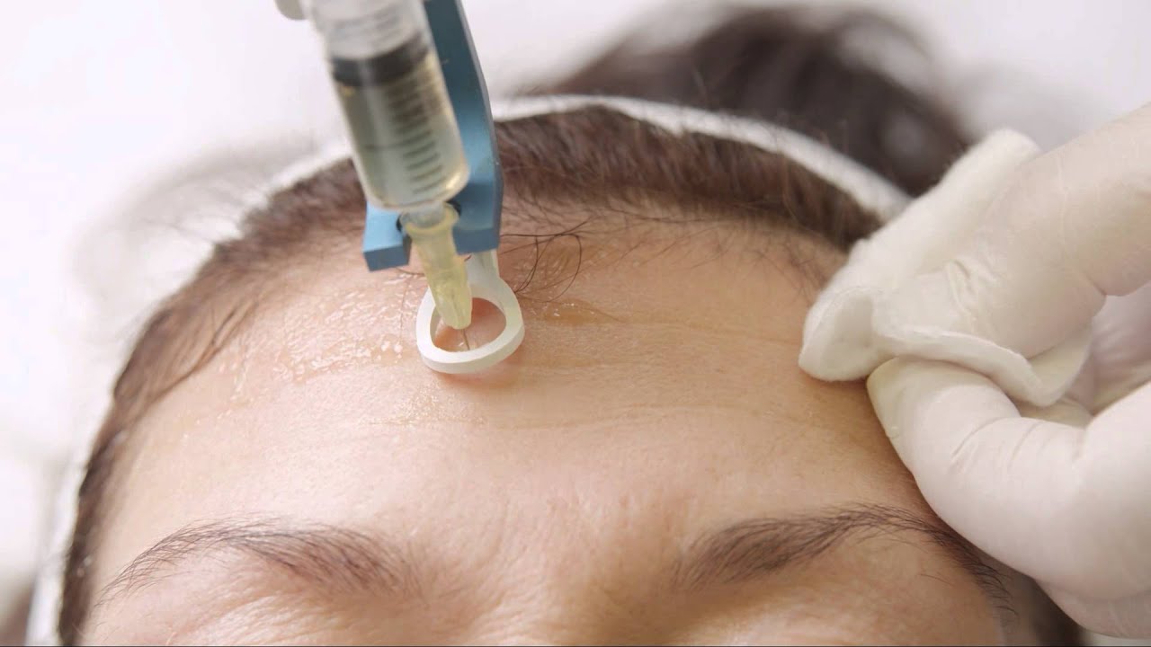 face-mesotherapy