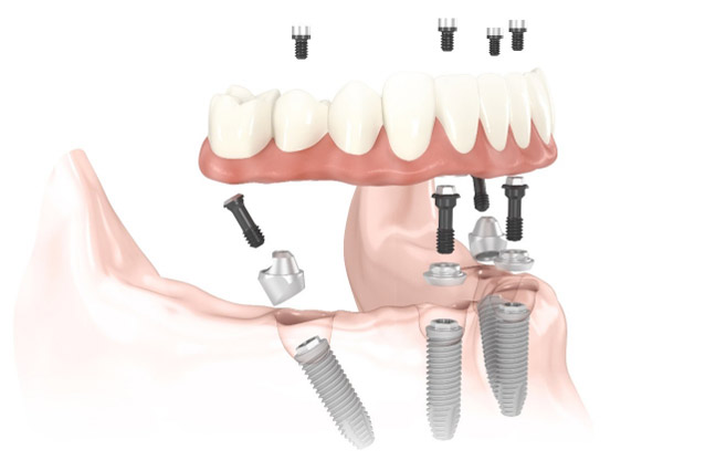 all-on-4-dental-implants